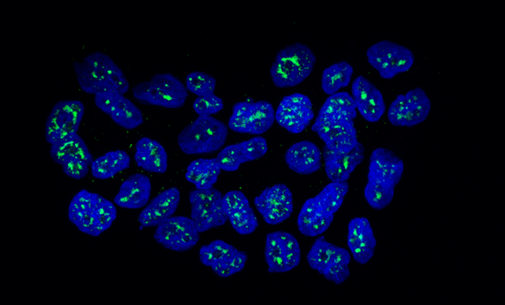 Identifican una proteína que mantiene dormidas las células metastásicas del cáncer de mama
