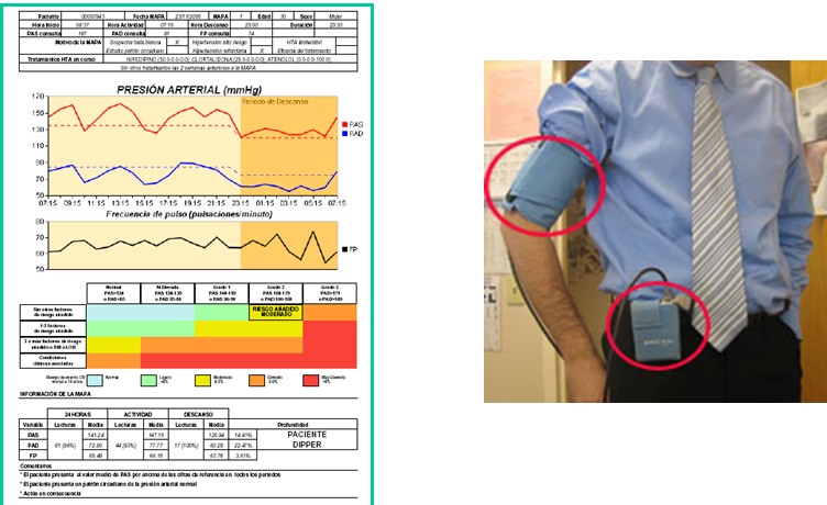 Medir la presión arterial durante 24 horas puede mejorar el diagnóstico y manejo de la hipertensión