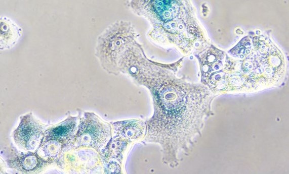 Las células senescentes podrían favorecer en algunas circunstancias la progresión maligna del tumor