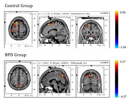 Las personas con trastorno límite de la personalidad activan regiones cerebrales distintas para controlar sus impulsos