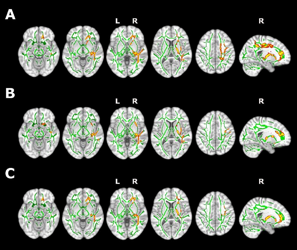 Encuentran cambios en la estructura cerebral y la cognición en personas con insomnio