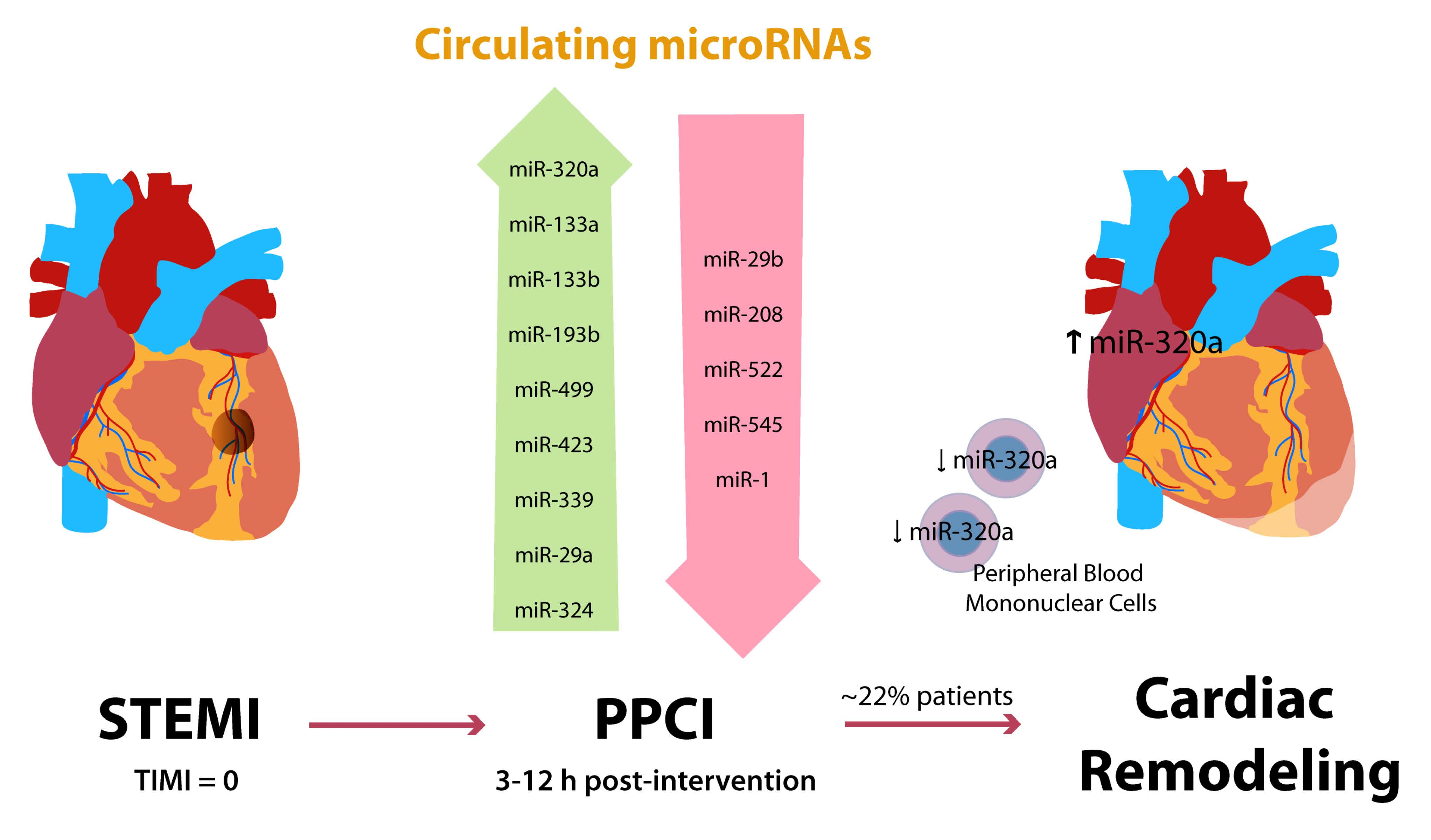Encuentran un posible marcador pronóstico de remodelado cardiaco tras infarto revascularizado