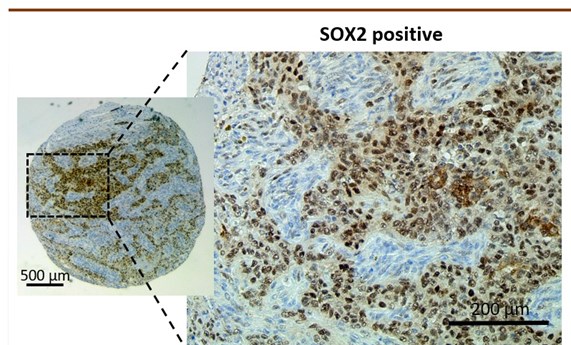 La proteína SOX2, posible biomarcador para conocer la evolución tumoral y la eficacia de fármacos en un tipo de sarcoma