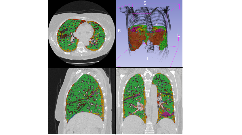 Identifican cambios en el tejido pulmonar de los fumadores que preceden a la enfermedad mediante análisis de datos