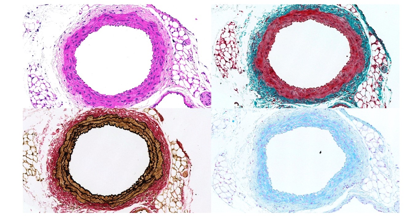 Primer tratamiento farmacológico para revertir aneurismas de aorta