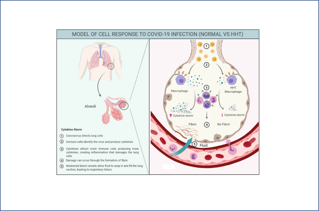 Sugieren que la COVID-19 tiene un menor impacto clínico en los afectados por telangiectasia hemorrágica hereditaria