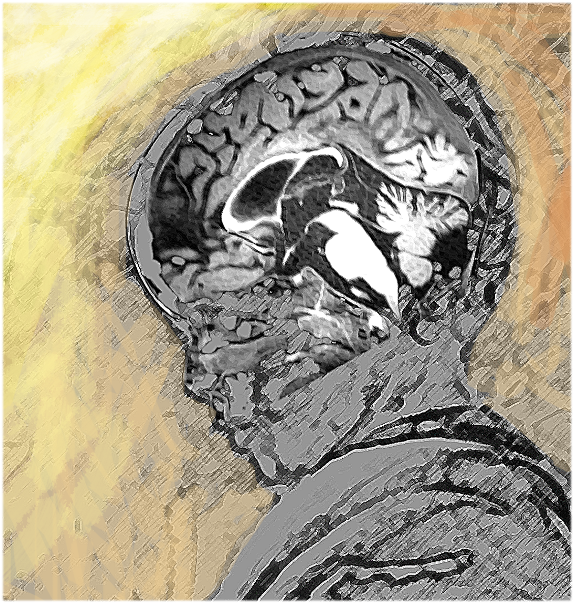 Identifican un gen causante de un nuevo síndrome neurológico y óseo