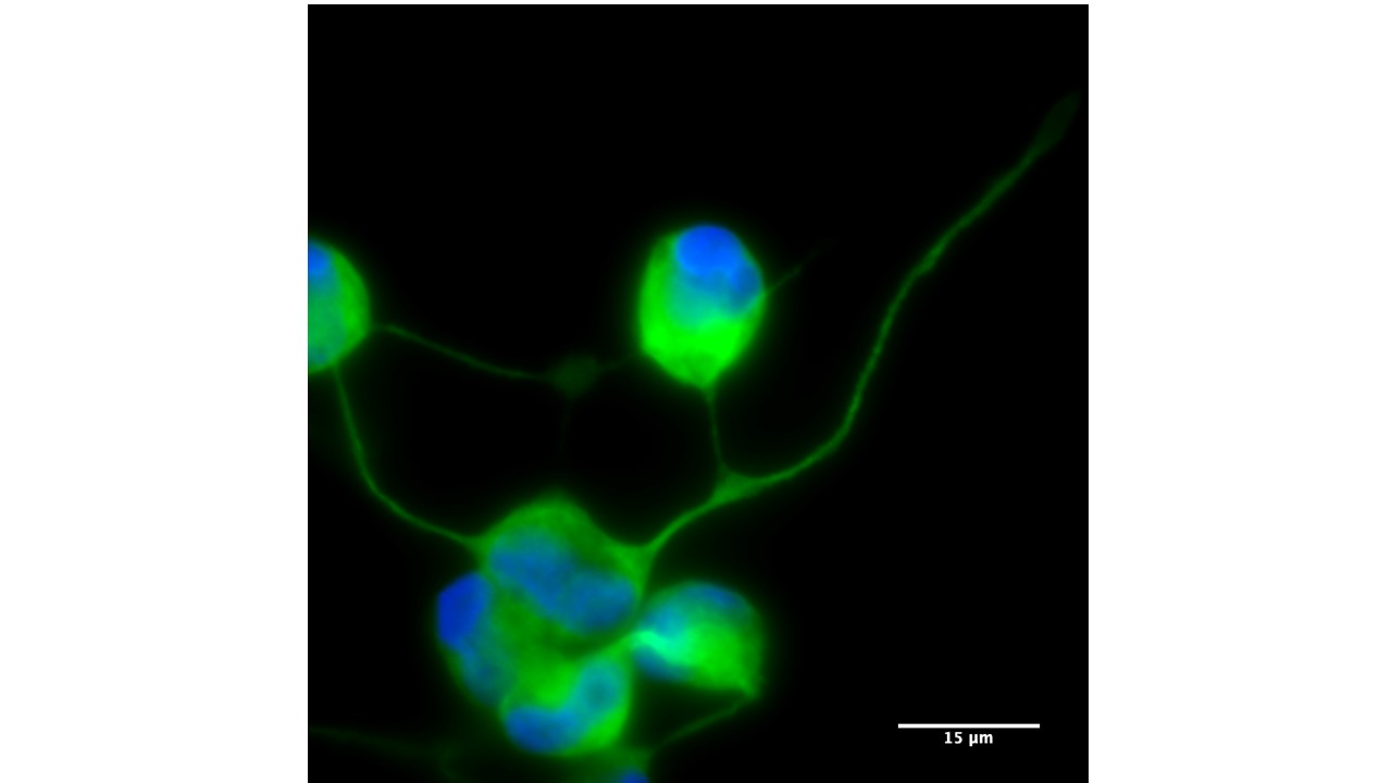 Generan neuronas mediante reprogramación directa de las células de la piel de pacientes mitocondriales con el síndrome MELAS