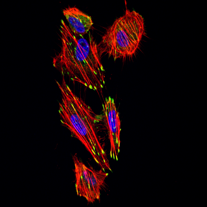 Inhibición de la dimerización de ERK para el tratamiento del carcinoma anaplásico de tiroides