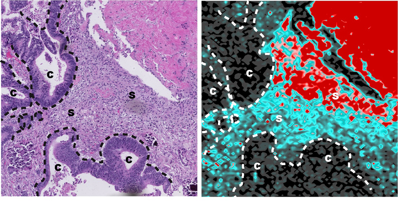 Descubren el mecanismo por el cual las células tumorales se hacen resistentes a la quimioterapia en cáncer de colon y recto