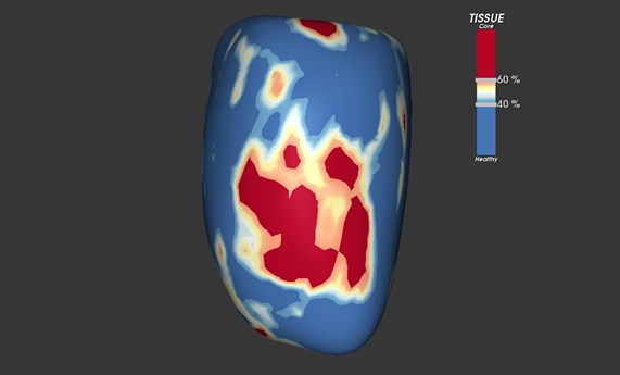 El estudio CIBER-SPANISH 1 comienza la inclusión del primer paciente El estudio CIBER-SPANISH 1 comienza la inclusión del primer paciente