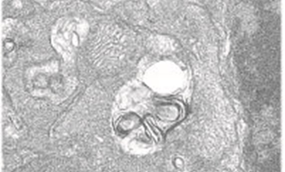 La autofagia resuelve la inflamación retiniana causada por el déficit en IGF-1 en el ratón La autofagia resuelve la inflamación retiniana causada por el déficit en IGF-1 en el ratón