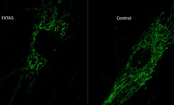 Identifican un nuevo mecanismo mitocondrial implicado en la patogénesis del síndrome FXTAS Identifican un nuevo mecanismo mitocondrial implicado en la patogénesis del síndrome FXTAS