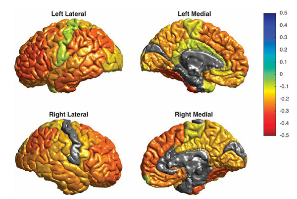 Elaborado el primer mapa global de las alteraciones cerebrales en pacientes con trastorno bipolar